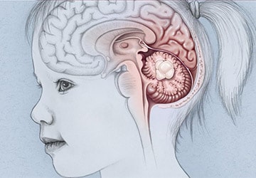 آنچه والدین باید درباره تومورهای مغزی کودک بدانند