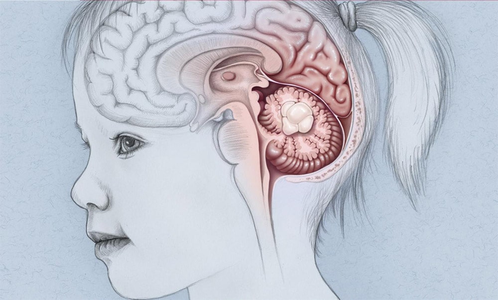 تومورهای مغزی در کودکان