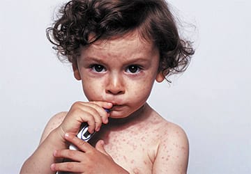 نشانه ها و علائم سرخک در کودکان چیست؟