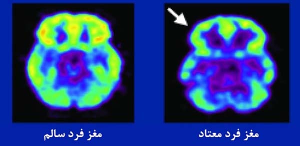 مغز فرد مصرف کننده ریتالین